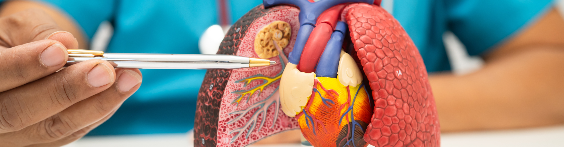 Mesothelioma or lung cancer?
