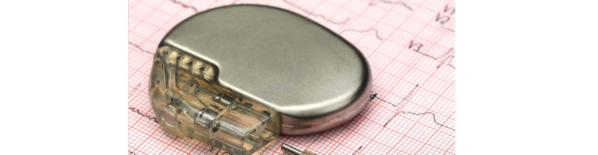 Pacemaker PTSD?